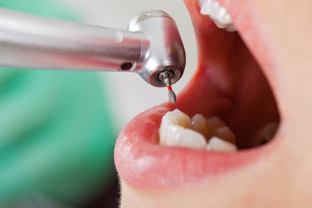 Best Lost Filling or Crown Replacement in Sans Souci, SC
